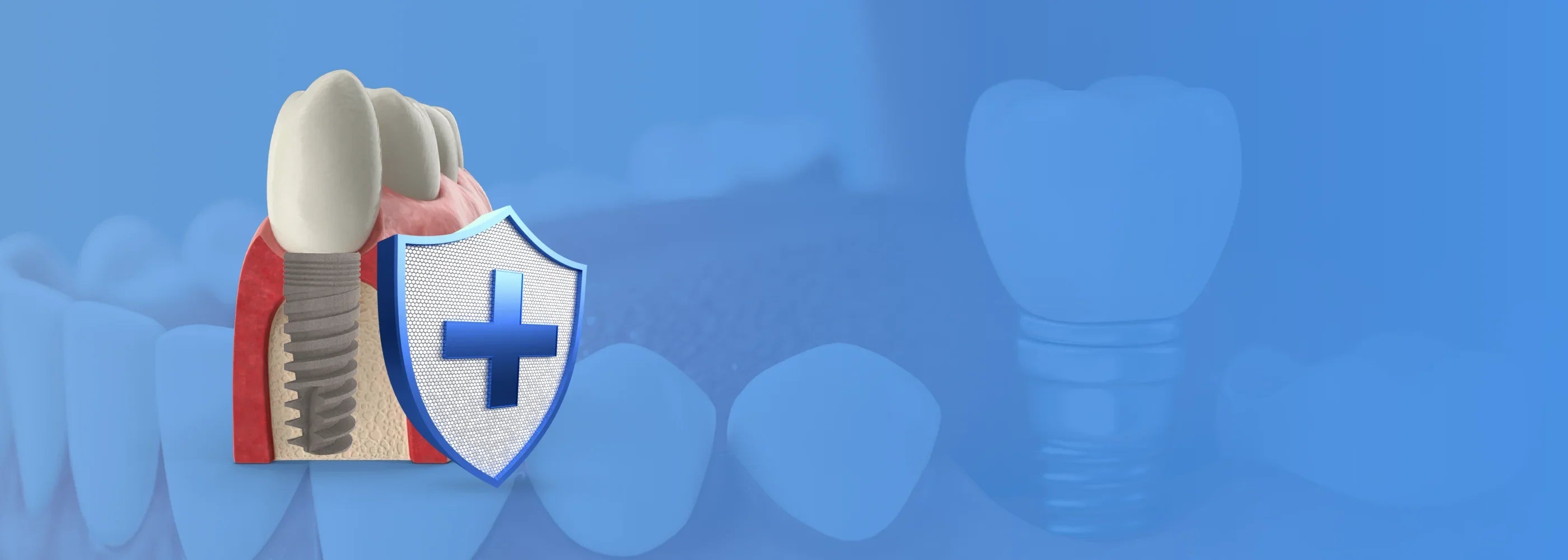 GDT Supply USA banner showing a 3D dental implant model with a protective shield and the text ‘Lifetime Warranty on Dental Implants – Built to last, covered for life.